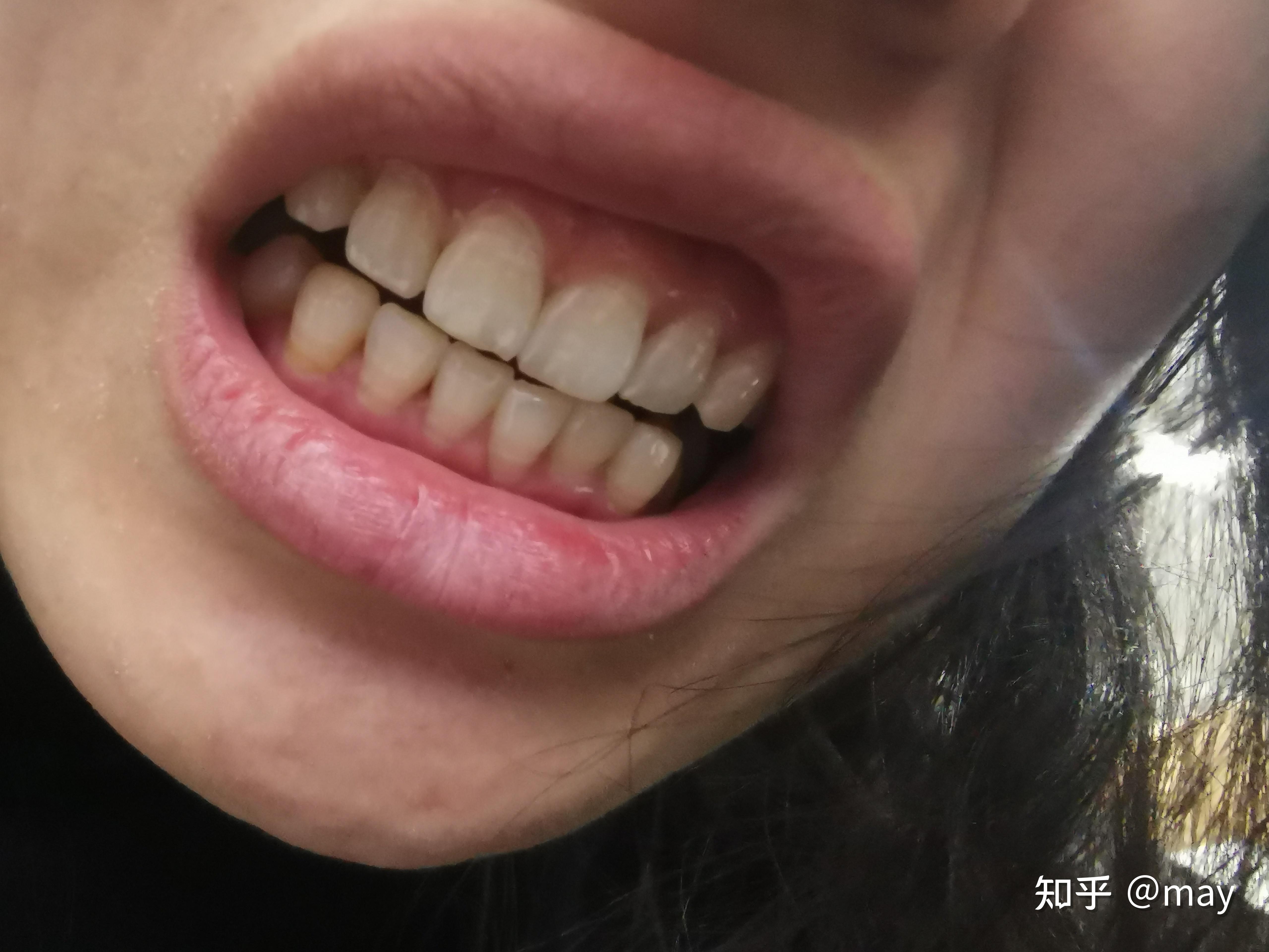牙周病 | Yateeth Dental | Family Friendly Camberwell Dentist | VIC 3142
