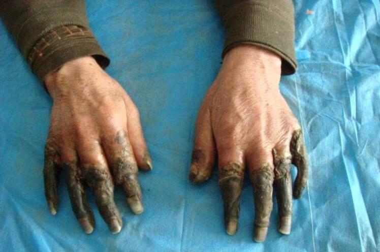 如何看待初一女孩在学校扫雪3小时手指被严重冻伤险遭截肢校方是否应