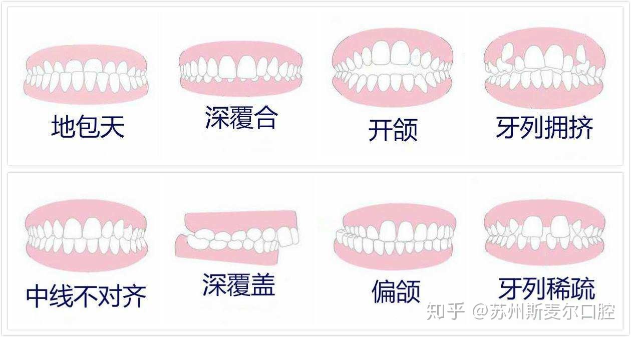 明星同款舌侧矫正,让你只见微笑,不见牙套 - 知乎
