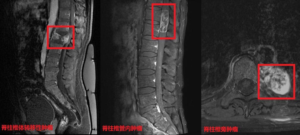 脊柱肿瘤科普—脊柱肿瘤相关知识问答 - 知乎