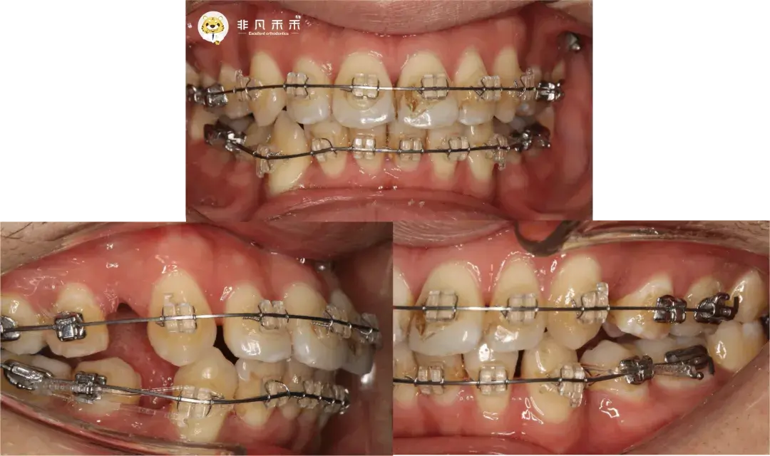 拔掉四颗牙齿矫正图图片