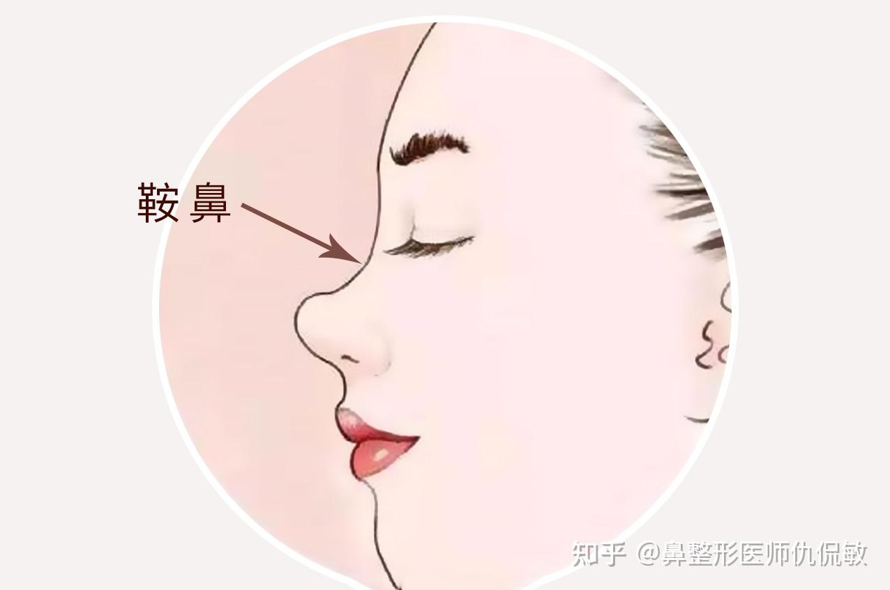 鞍鼻形成的原因都有哪些? - 知乎