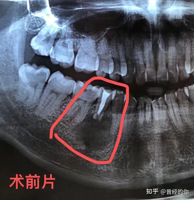 口腔牙根囊肿图片图片