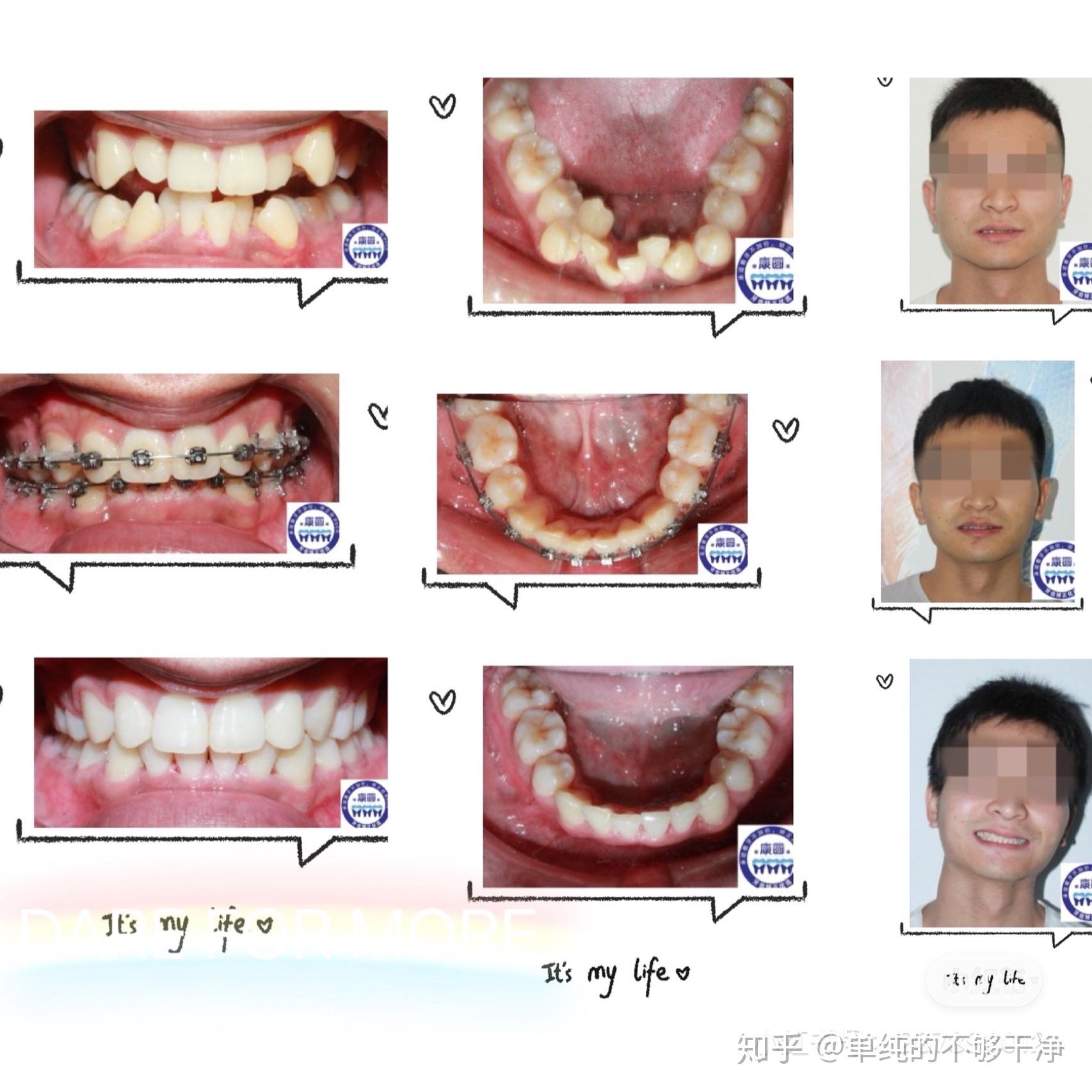 廣州牙齒矯正哪裡好28歲寶生廣州矯正亂牙變化翻天覆地