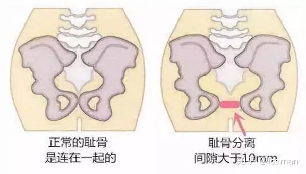 耻骨联合分离 产后难以言语的痛 知乎