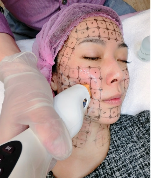 电波拉皮的效果怎么样