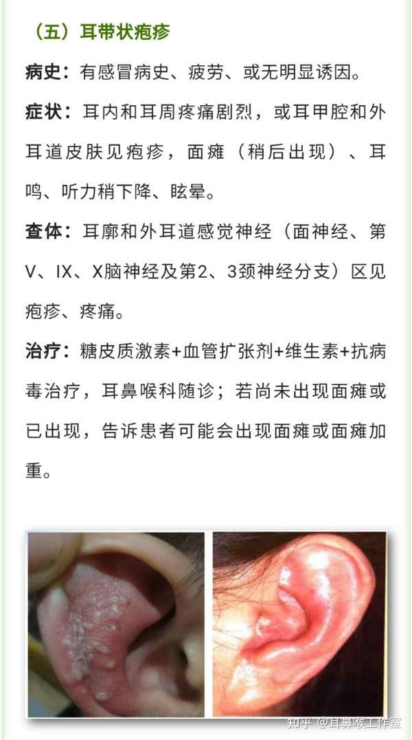 各种类型的耳部疾病诊疗汇总 - 知乎