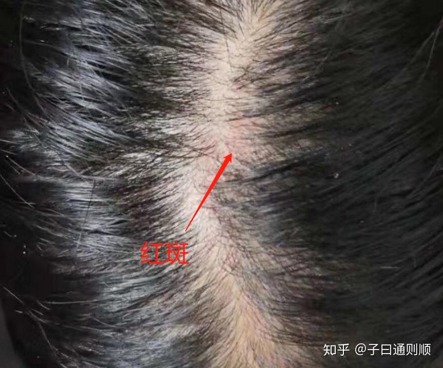 为什么脂溢性脱发者头皮会有红斑? - 知乎