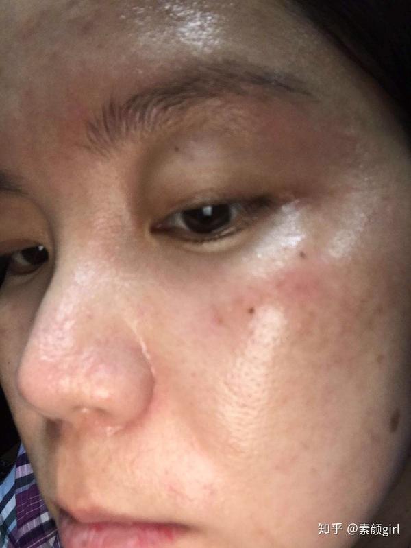 角质层薄如何修复?