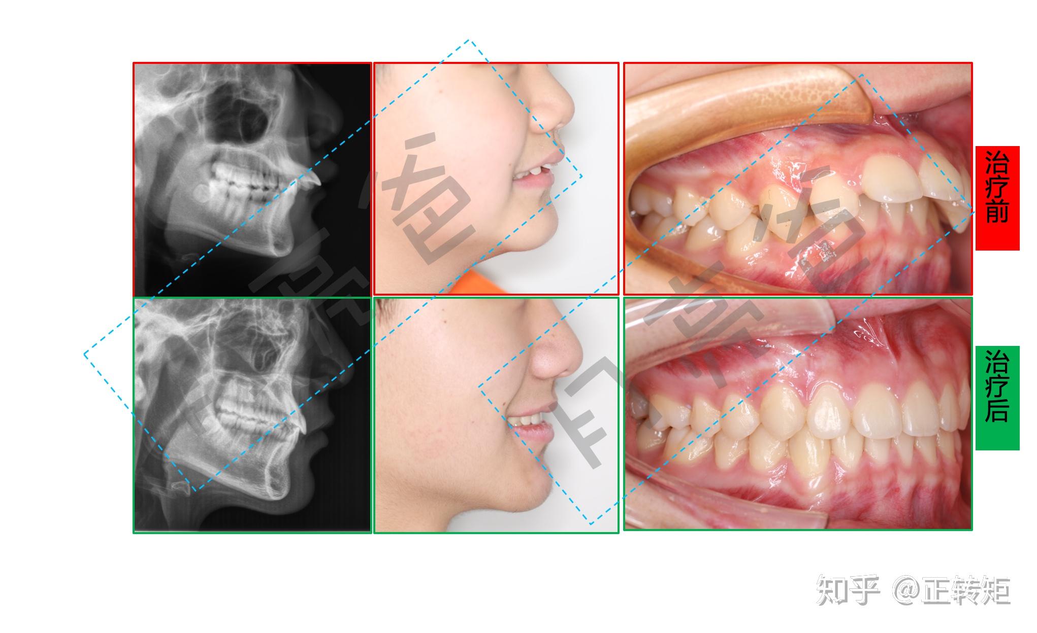 正畸治疗中的面型变化