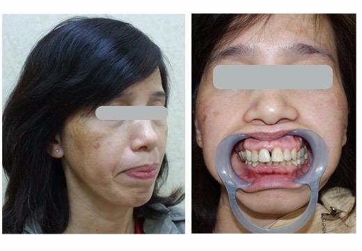 转载来自台湾黄奇卿医生的颞下颌关节紊乱科普文三篇