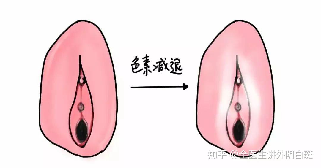 女人得性疾病什么症状图片