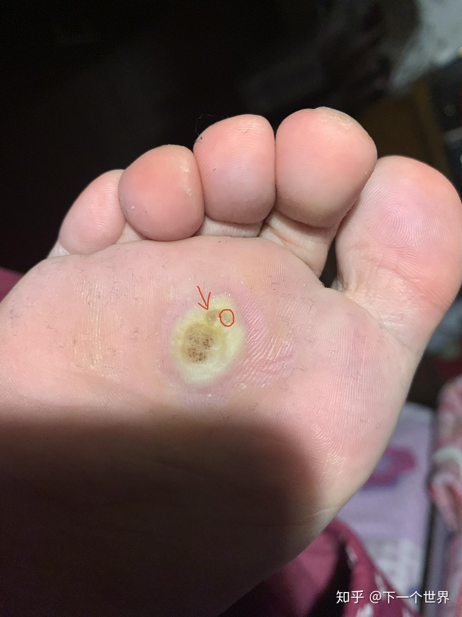 我的跖疣终于治好啦!