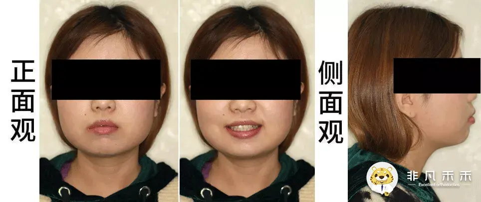 正畸病例嘴突没下巴拔牙病例一例