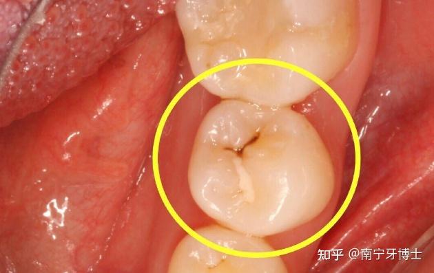 牙釉质被细菌龋坏,但不痛不痒,会出现窝沟龋得及时补牙,而不是去洗牙