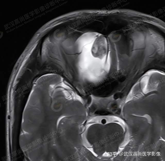 罕见的前颅窝神经鞘瘤武汉高尚医学影像