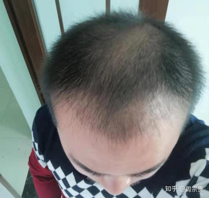 三级脱发2000单位术后效果怎么样