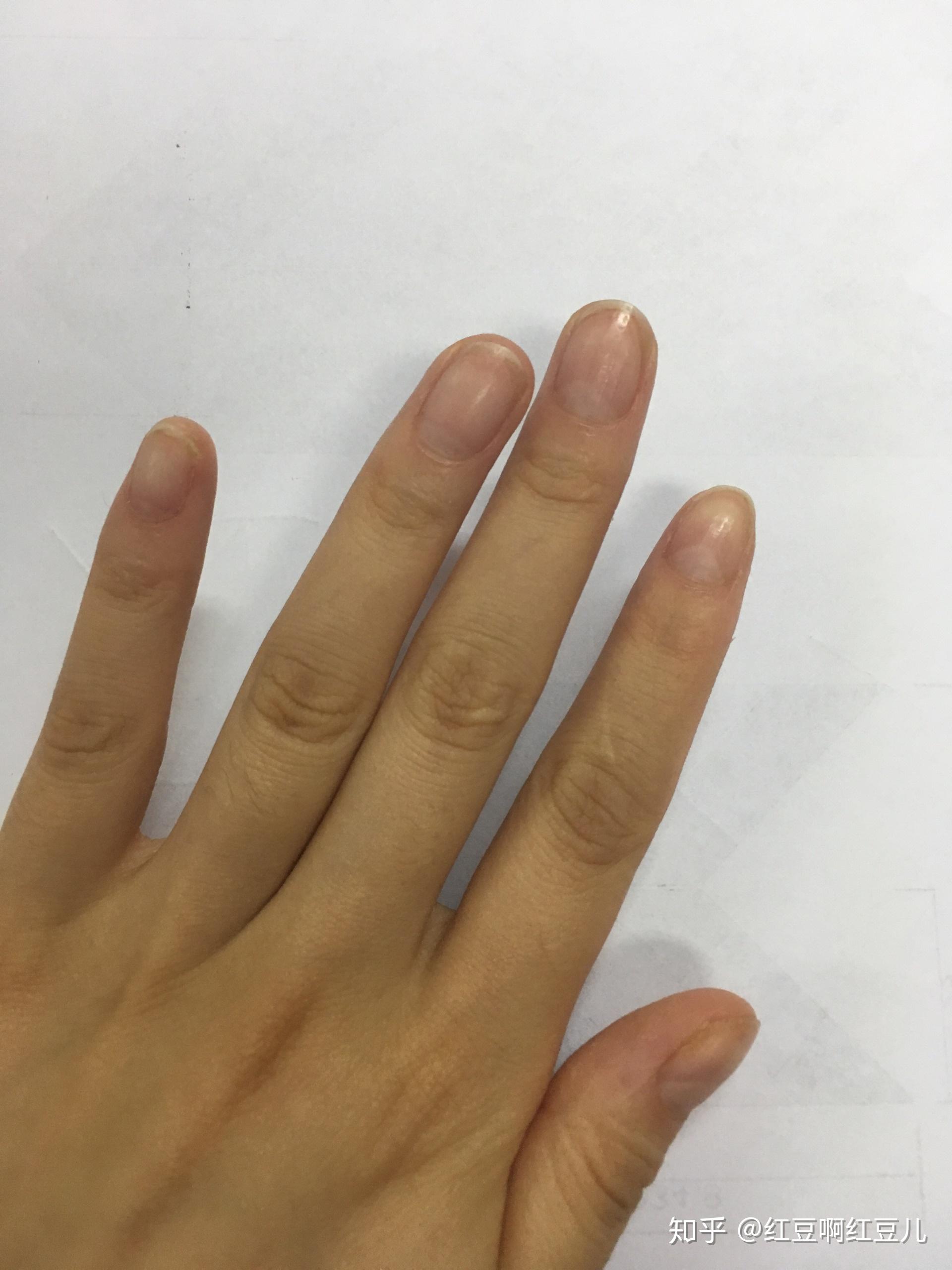 我是怎么治疗指甲凹凸不平、手指脱皮的现象 - 知乎
