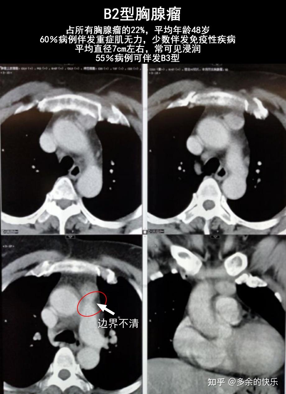 胸腺癌治疗那些事（十四） 知乎