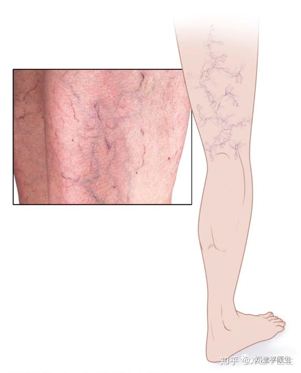 什么是毛细血管扩张红血丝