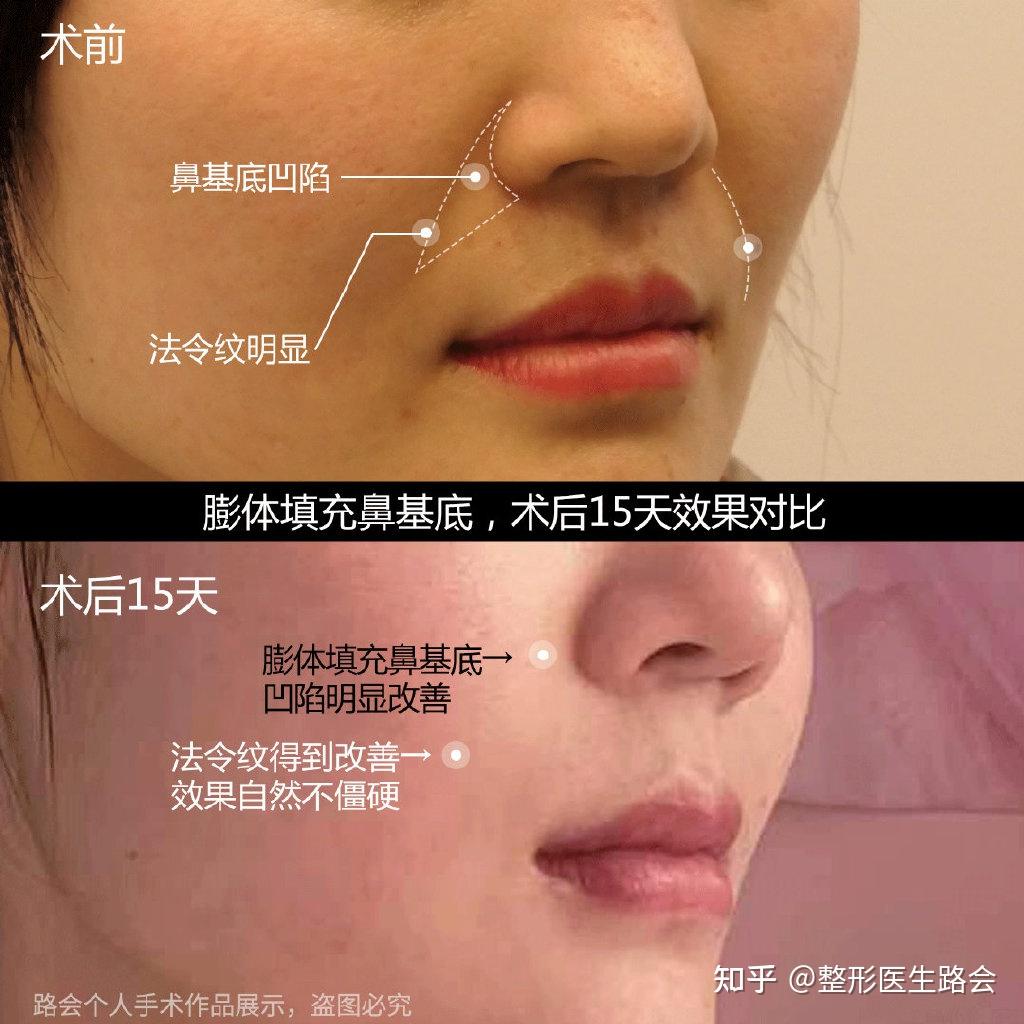 有法令纹或者嘴凸就是鼻基底凹陷吗如何自我判断