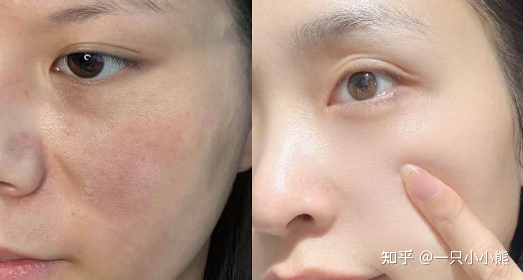 先看我皮肤的前后对比,有图有真相,这就是可信度!