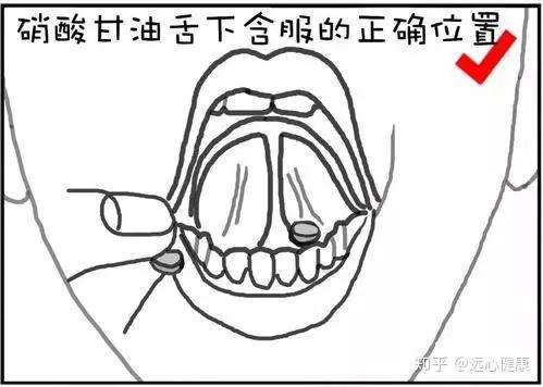 硝酸甘油的正确服用方法是舌下含服,在这个过程中,患者会有涩辣,灼烧