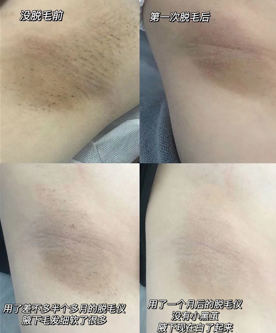 非常明显还扎人不过也可能因人而异吧(2)脱毛膏每次全身脱毛用起来巨