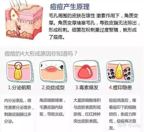 闭口类型图解图片