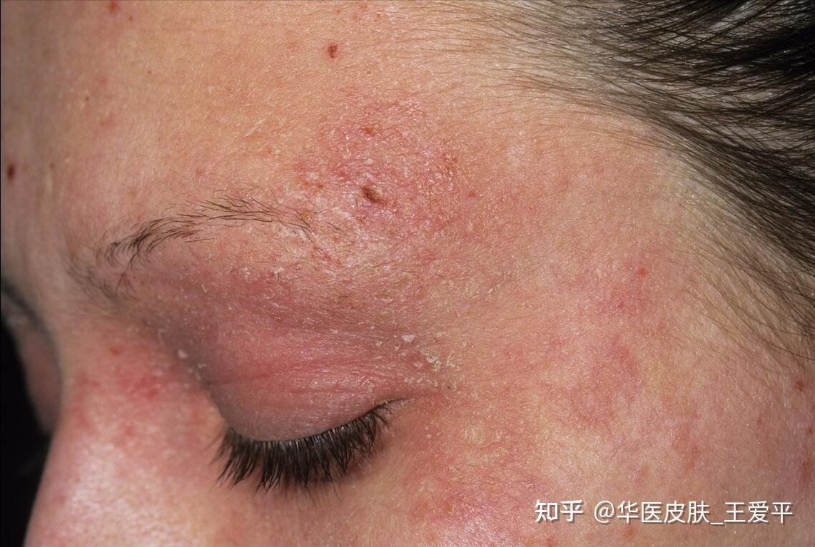 湿疹、皮炎傻傻分不清？只看一个症状！ - 知乎