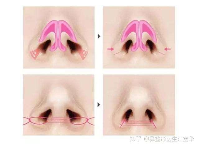 缩鼻翼内切和外切如何选择利弊关系