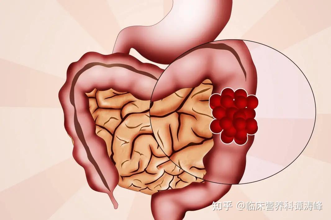 消化系統腫瘤佔中國癌症死亡率的50腸道菌群成為治療的新方向