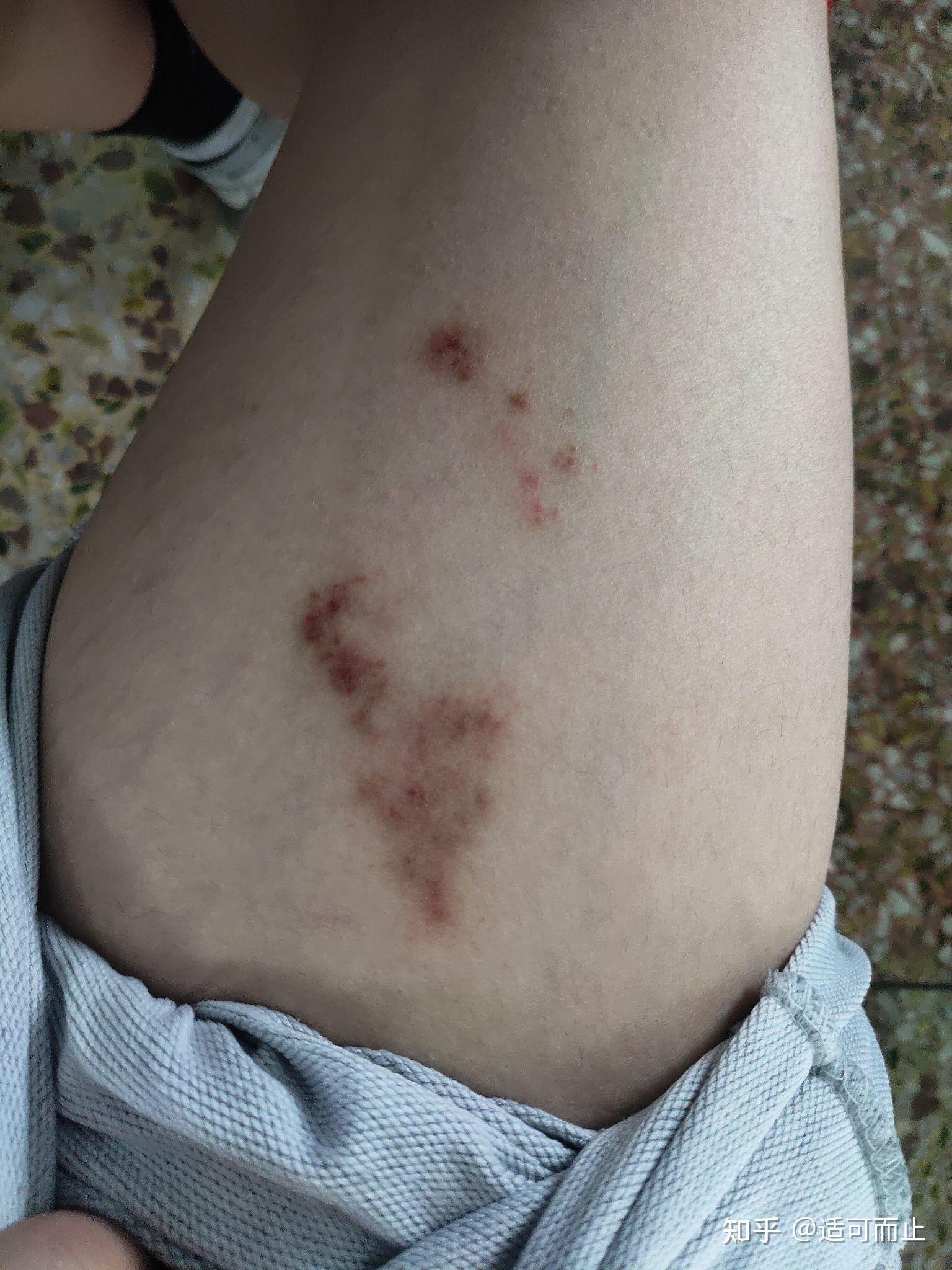腿上长了一片不痛不痒的红块,这是什么皮肤病? 
