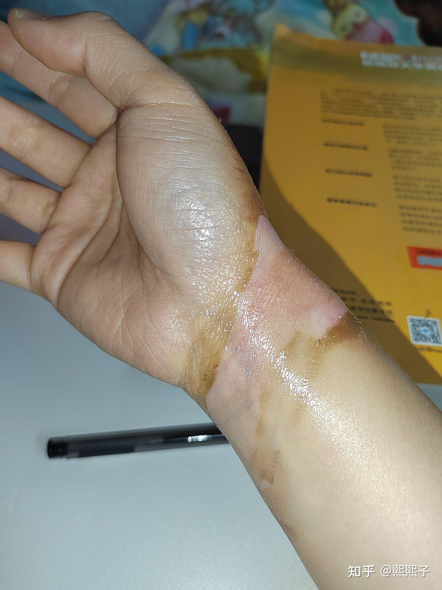 记录一下被烫伤的恢复过程