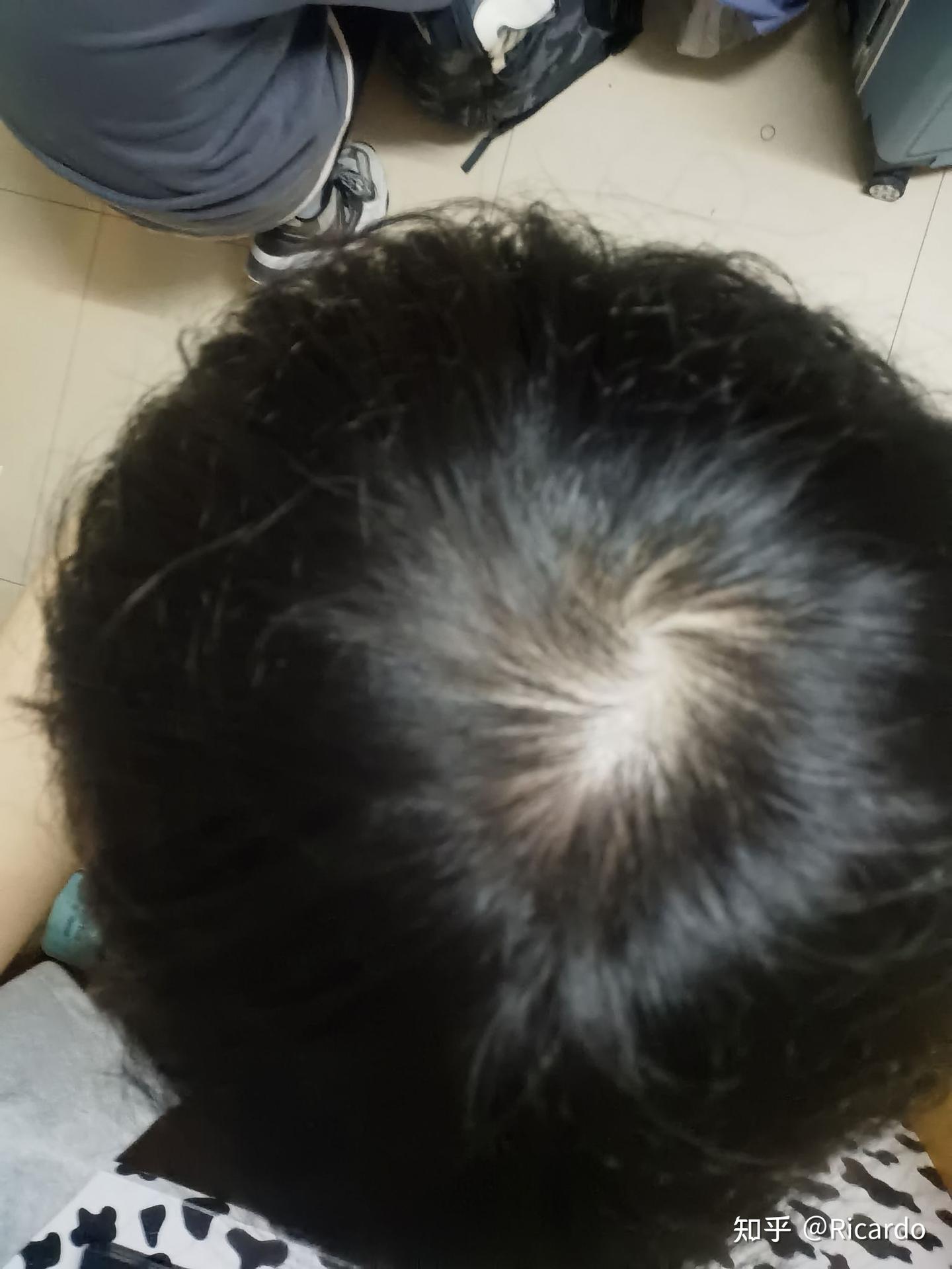 头旋处脱发怎么办,我睡眠质量不好,也容易熬夜,导致头旋处头发稀少,还能养回来吗 - 知乎