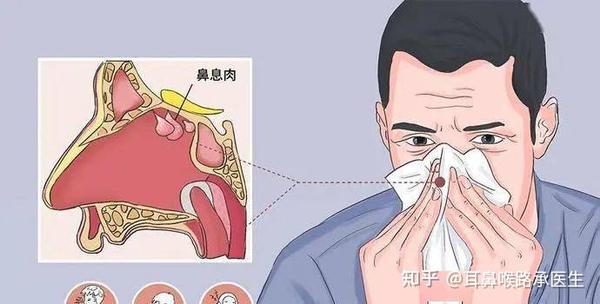 鼻息肉必须要手术治疗吗?以下内容告诉你 - 知乎