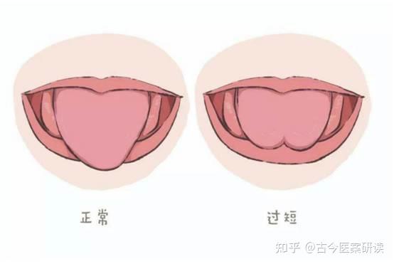 上唇系带正常位置图片图片