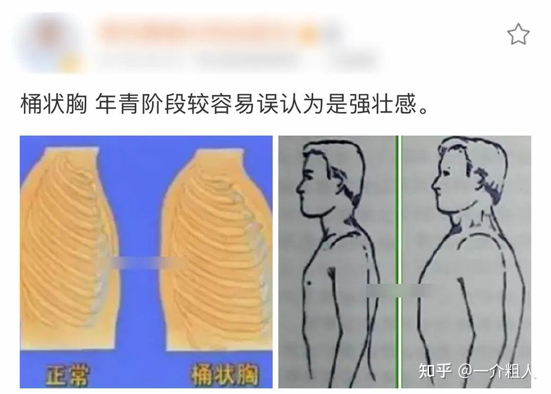 正常的胸桶状胸图片