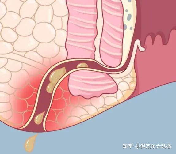 肛瘘是感染性的疾病,它是由肛窦,也就是肛门里头大概1.
