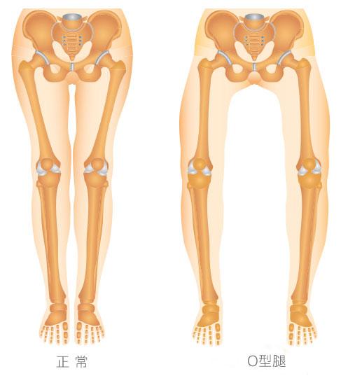 我都成年了,弯了的腿还能变直吗?