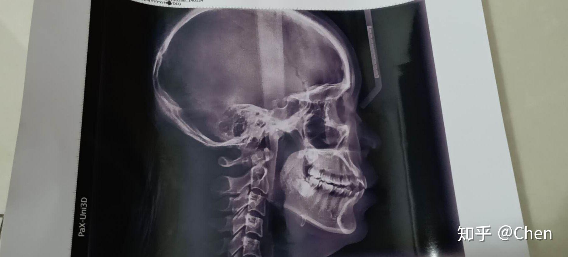 拔智齿矫正凸嘴可以吗?