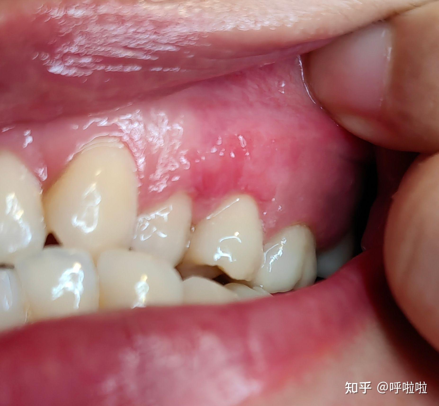 牙龈扁平苔藓症状图片图片