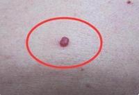 防微杜渐改善显性肝性脑病预后从管理轻微型肝性脑病