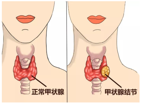 『甲状腺结节』投保指南