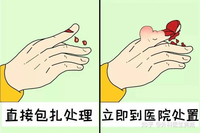 「今日推荐」遇到手外伤如何急救处理?