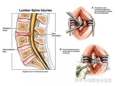 腰间盘突出微创手术是什么原理_腰间盘突出微创手术图(3)