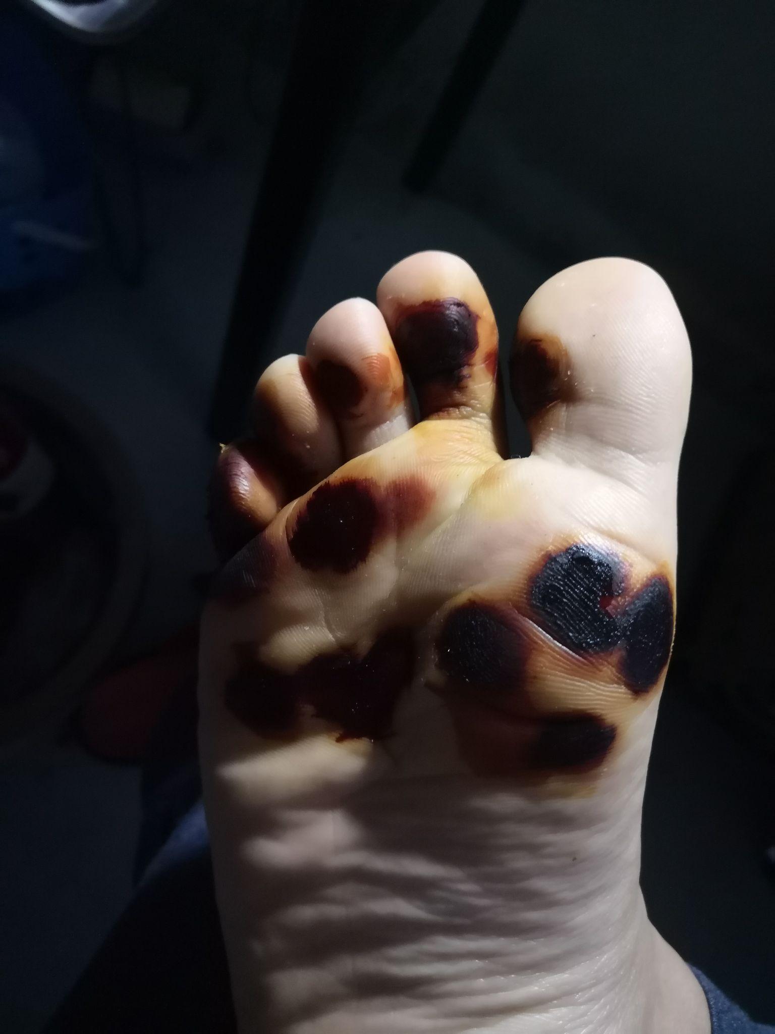 趾疣半年治疗之路