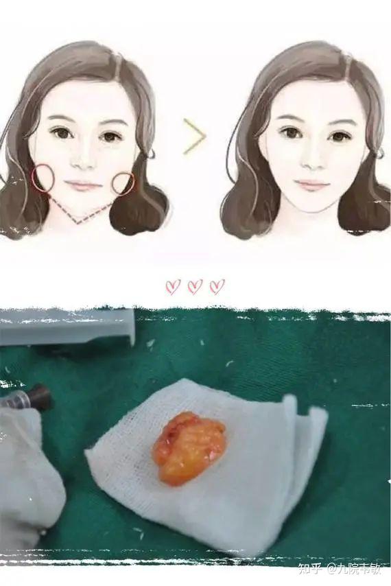 尤其是取颊脂垫占据面颊一定体积,摘除后面部脂肪感就会明显减少,且