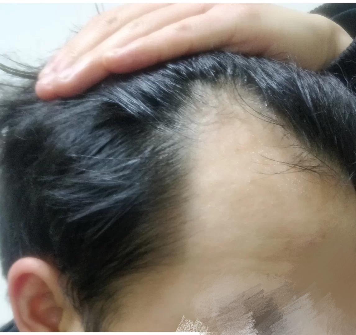遗传脱发一般几岁开始？遗传性秃顶一般几岁会显现？ - 知乎