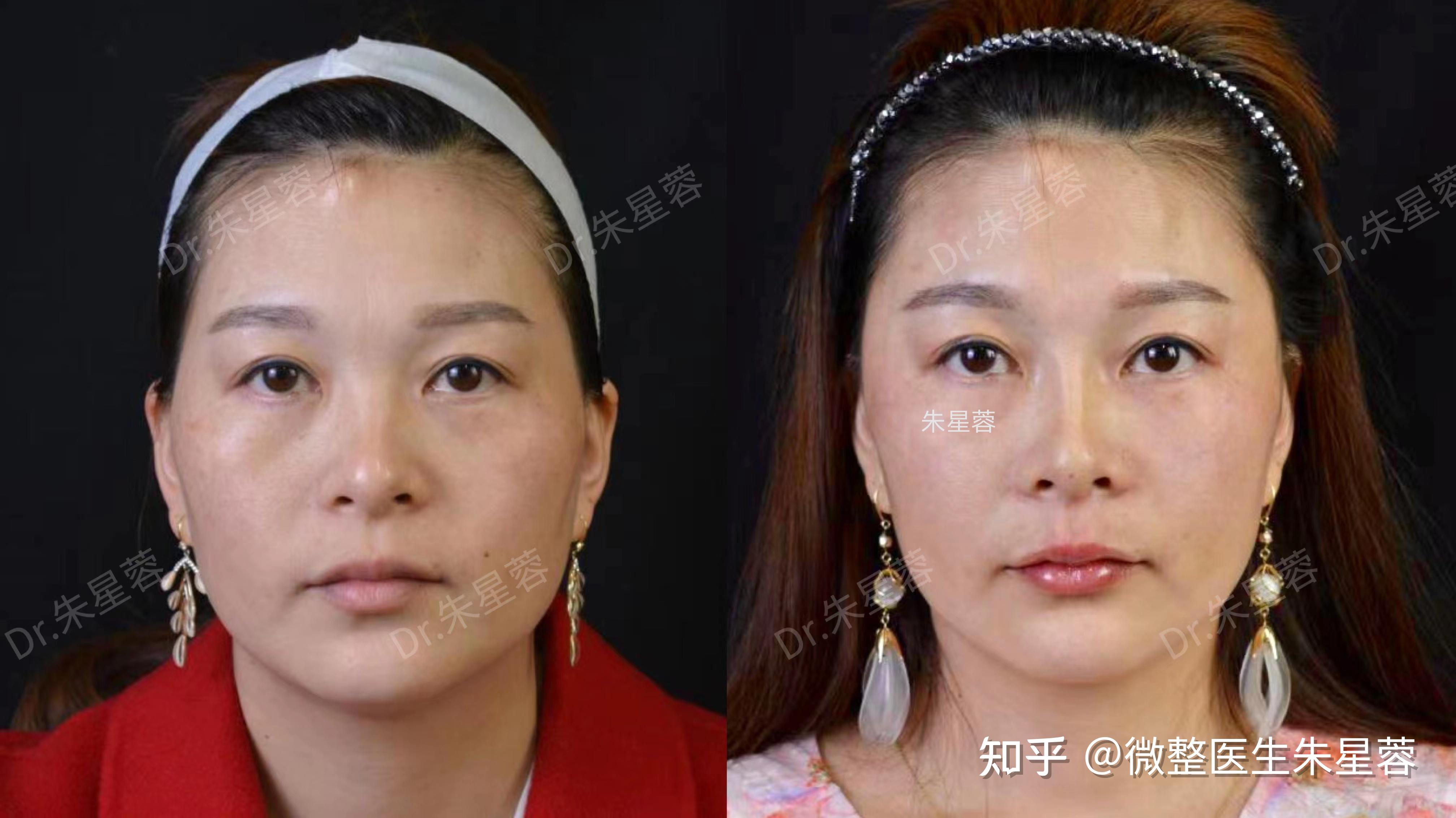 苹果肌和颧骨颧弓的区别 - 知乎